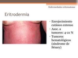 Eritrodermia
• Enrojecimiento
cutáneo extenso
• Asoc. a
tumores: 4-21 %
• Tumores
hematológicos
(síndrome de
Sézary)
Enfermedades eritematosas
 