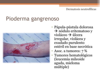 Pioderma gangrenoso
• Pápula-pústula dolorosa
 nódulo eritematoso y
violáceo  úlcera
irregular, violácea y
exudado purulento
estéril en base necrótica
• Asoc. a tumores: 7 %
• Tumores hematológicos
(leucemia mileoide
aguda, mieloma
múltiple)
Dermatosis neutrofílicas
 
