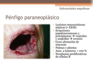 Pénfigo paraneoplásico
• Lesiones mucocutáneas
atípicas (≈ EEM)
• Erupciones
papuloescamosas y
pruriginosas  vesículas
y ampollas  erosión
• Gran afectación de
mucosas
• Palmas y plantas
• Asoc. a tumores: ≈ 100 %
• Neoplasias proliferativas
de células B
Enfermedades ampollosas
 
