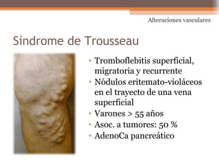 Síndrome de Trousseau
• Tromboflebitis superficial,
migratoria y recurrente
• Nódulos eritemato-violáceos
en el trayecto de una vena
superficial
• Varones > 55 años
• Asoc. a tumores: 50 %
• AdenoCa pancreático
Alteraciones vasculares
 