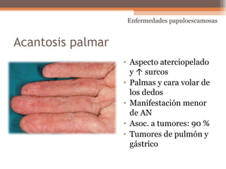 Acantosis palmar
• Aspecto aterciopelado
y ↑ surcos
• Palmas y cara volar de
los dedos
• Manifestación menor
de AN
• Asoc. a tumores: 90 %
• Tumores de pulmón y
gástrico
Enfermedades papuloescamosas
 