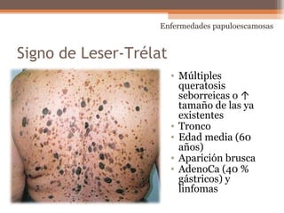 Signo de Leser-Trélat
• Múltiples
queratosis
seborreicas o ↑
tamaño de las ya
existentes
• Tronco
• Edad media (60
años)
• Aparición brusca
• AdenoCa (40 %
gástricos) y
linfomas
Enfermedades papuloescamosas
 