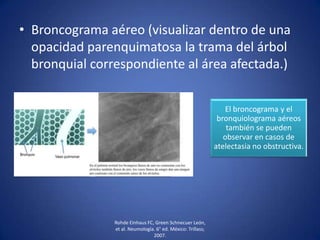 • Broncograma aéreo (visualizar dentro de una
opacidad parenquimatosa la trama del árbol
bronquial correspondiente al área afectada.)
Rohde Einhaus FC, Green Schnecuer León,
et al. Neumología. 6° ed. México: Trillass;
2007.
El broncograma y el
bronquiolograma aéreos
también se pueden
observar en casos de
atelectasia no obstructiva.
 