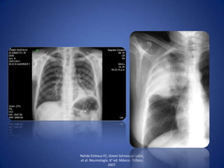 Rohde Einhaus FC, Green Schnecuer León,
et al. Neumología. 6° ed. México: Trillass;
2007.
 