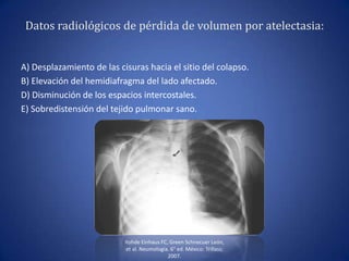 Datos radiológicos de pérdida de volumen por atelectasia:
A) Desplazamiento de las cisuras hacia el sitio del colapso.
B) Elevación del hemidiafragma del lado afectado.
D) Disminución de los espacios intercostales.
E) Sobredistensión del tejido pulmonar sano.
Rohde Einhaus FC, Green Schnecuer León,
et al. Neumología. 6° ed. México: Trillass;
2007.
 