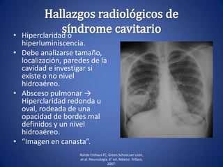 • Hiperclaridad o
hiperluminiscencia.
• Debe analizarse tamaño,
localización, paredes de la
cavidad e investigar si
existe o no nivel
hidroaéreo.
• Absceso pulmonar →
Hiperclaridad redonda u
oval, rodeada de una
opacidad de bordes mal
definidos y un nivel
hidroaéreo.
• “Imagen en canasta”.
Rohde Einhaus FC, Green Schnecuer León,
et al. Neumología. 6° ed. México: Trillass;
2007.
 
