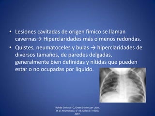 • Lesiones cavitadas de origen fímico se llaman
cavernas→ Hiperclaridades más o menos redondas.
• Quistes, neumatoceles y bulas → hiperclaridades de
diversos tamaños, de paredes delgadas,
generalmente bien definidas y nítidas que pueden
estar o no ocupadas por líquido.
Rohde Einhaus FC, Green Schnecuer León,
et al. Neumología. 6° ed. México: Trillass;
2007.
 