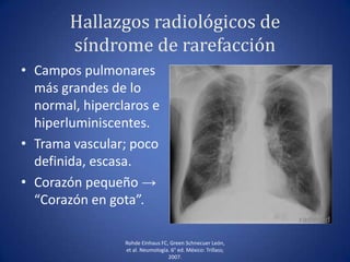 Hallazgos radiológicos de
síndrome de rarefacción
• Campos pulmonares
más grandes de lo
normal, hiperclaros e
hiperluminiscentes.
• Trama vascular; poco
definida, escasa.
• Corazón pequeño →
“Corazón en gota”.
Rohde Einhaus FC, Green Schnecuer León,
et al. Neumología. 6° ed. México: Trillass;
2007.
 