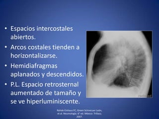 • Espacios intercostales
abiertos.
• Arcos costales tienden a
horizontalizarse.
• Hemidiafragmas
aplanados y descendidos.
• P.L. Espacio retrosternal
aumentado de tamaño y
se ve hiperluminiscente.
Rohde Einhaus FC, Green Schnecuer León,
et al. Neumología. 6° ed. México: Trillass;
2007.
 
