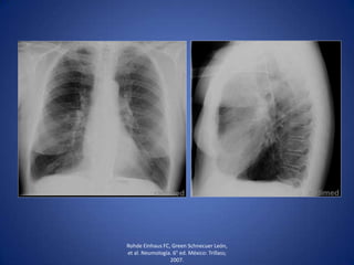 Rohde Einhaus FC, Green Schnecuer León,
et al. Neumología. 6° ed. México: Trillass;
2007.
 