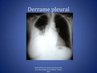 Derrame pleural
Rohde Einhaus FC, Green Schnecuer León,
et al. Neumología. 6° ed. México: Trillass;
2007.
 