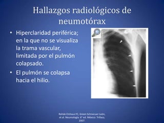 Hallazgos radiológicos de
neumotórax
• Hiperclaridad periférica;
en la que no se visualiza
la trama vascular,
limitada por el pulmón
colapsado.
• El pulmón se colapsa
hacia el hilio.
Rohde Einhaus FC, Green Schnecuer León,
et al. Neumología. 6° ed. México: Trillass;
2007.
 