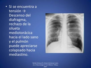 • Si se encuentra a
tensión →
Descenso del
diafragma,
rechazo de la
silueta
mediotorácica
hacia el lado sano
y el pulmón
puede apreciarse
colapsado hacia
mediastino.
Rohde Einhaus FC, Green Schnecuer León,
et al. Neumología. 6° ed. México: Trillass;
2007.
 