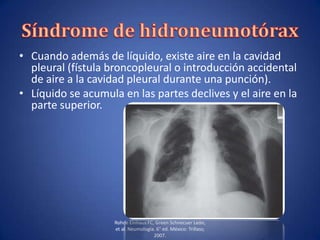 • Cuando además de líquido, existe aire en la cavidad
pleural (fístula broncopleural o introducción accidental
de aire a la cavidad pleural durante una punción).
• Líquido se acumula en las partes declives y el aire en la
parte superior.
Rohde Einhaus FC, Green Schnecuer León,
et al. Neumología. 6° ed. México: Trillass;
2007.
 