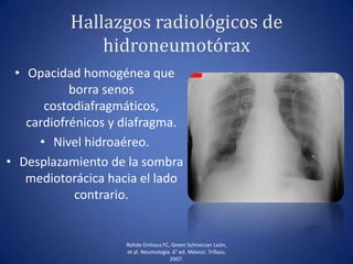 Hallazgos radiológicos de
hidroneumotórax
• Opacidad homogénea que
borra senos
costodiafragmáticos,
cardiofrénicos y diafragma.
• Nivel hidroaéreo.
• Desplazamiento de la sombra
mediotorácica hacia el lado
contrario.
Rohde Einhaus FC, Green Schnecuer León,
et al. Neumología. 6° ed. México: Trillass;
2007.
 