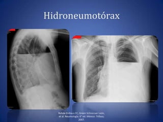 Hidroneumotórax
Rohde Einhaus FC, Green Schnecuer León,
et al. Neumología. 6° ed. México: Trillass;
2007.
 
