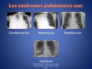 Condensación Atelectasia Rarefacción
Cavitario
Rohde Einhaus FC, Green Schnecuer León,
et al. Neumología. 6° ed. México: Trillass;
2007.
 