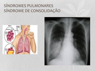 SÍNDROMES PULMONARES
SÍNDROME DE CONSOLIDAÇÃO
 