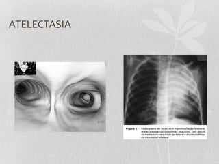 ATELECTASIA
 