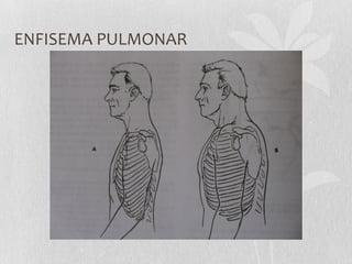 ENFISEMA PULMONAR
 