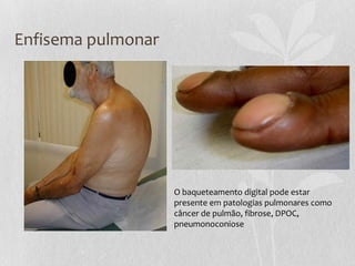 Enfisema pulmonar
O baqueteamento digital pode estar
presente em patologias pulmonares como
câncer de pulmão, fibrose, DPOC,
pneumonoconiose
 