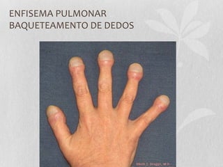ENFISEMA PULMONAR
BAQUETEAMENTO DE DEDOS
 