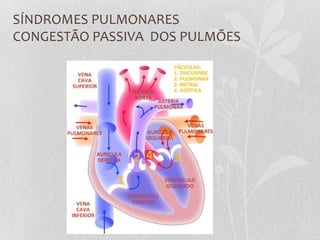 SÍNDROMES PULMONARES
CONGESTÃO PASSIVA DOS PULMÕES
 