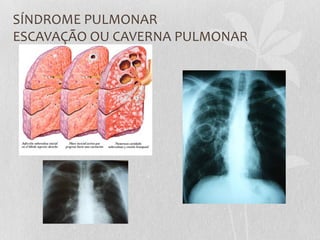 SÍNDROME PULMONAR
ESCAVAÇÃO OU CAVERNA PULMONAR
 