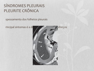 SÍNDROMES PLEURAIS
PLEURITE CRÔNICA
spessamento dos folhetos pleurais
rincipal sintomas é a dispneia aos grandes esforços
 