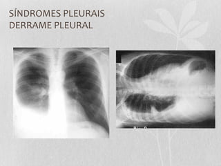 SÍNDROMES PLEURAIS
DERRAME PLEURAL
 