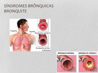 SÍNDROMES BRÔNQUICAS
BRONQUITE
 