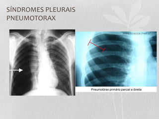 SÍNDROMES PLEURAIS
PNEUMOTORAX
 