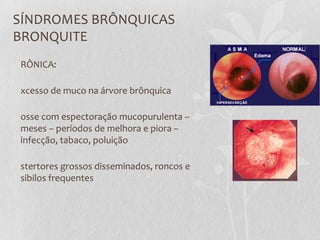 SÍNDROMES BRÔNQUICAS
BRONQUITE
RÔNICA:
xcesso de muco na árvore brônquica
osse com espectoração mucopurulenta –
meses – períodos de melhora e piora –
infecção, tabaco, poluição
stertores grossos disseminados, roncos e
sibilos frequentes
 
