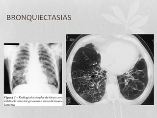 BRONQUIECTASIAS
 