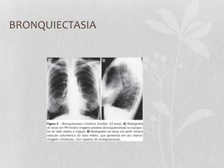 BRONQUIECTASIA
 