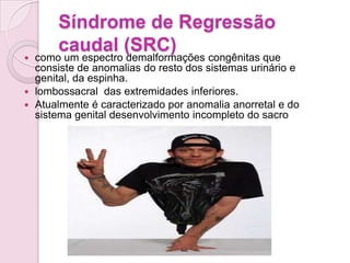 Síndrome de Regressão
      caudal (SRC)
 como um espectro demalformações congênitas que
  consiste de anomalias do resto dos sistemas urinário e
  genital, da espinha.
 lombossacral das extremidades inferiores.
 Atualmente é caracterizado por anomalia anorretal e do
  sistema genital desenvolvimento incompleto do sacro
 