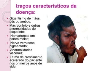 traços característicos da
        doença:
   Gigantismo de mãos,
    pés ou ambos;
   Macrocrânio e outras
    anormalidades de
    esqueleto;
    Hamartomas em
    partes moles;
    Nervo verrucoso
    pigmentado;
   Anormalidades
    viscerais;
    Ritmo de crescimento
    acelerado do paciente
    nos primeiros anos de
    vida.
 