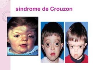 síndrome de Crouzon
 