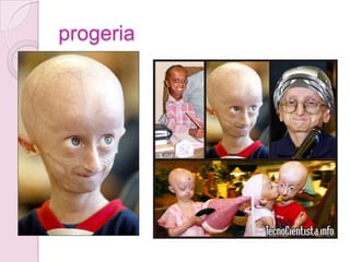 progeria
 