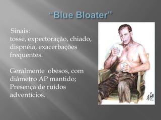 Sinais:
tosse, expectoração, chiado,
dispnéia, exacerbações
frequentes.
Geralmente obesos, com
diâmetro AP mantido;
Presença de ruídos
adventícios.
 