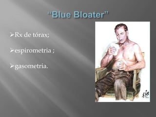 Rx de tórax;
espirometria ;
gasometria.
 