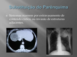  Sintomas ocorrem por extravasamento de
conteúdo cístico, ou invasão de estruturas
adjacentes.
 