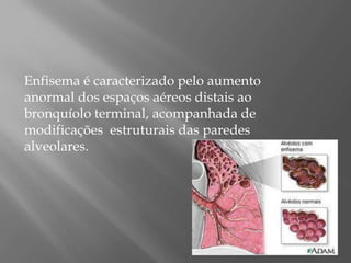 Enfisema é caracterizado pelo aumento
anormal dos espaços aéreos distais ao
bronquíolo terminal, acompanhada de
modificações estruturais das paredes
alveolares.
 