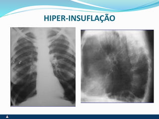 HIPER-INSUFLAÇÃO
 