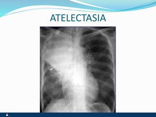 ATELECTASIA
 