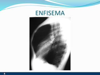 ENFISEMA
 