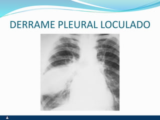 DERRAME PLEURAL LOCULADO
 