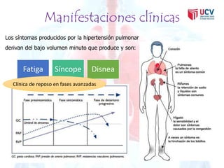 Manifestaciones clínicas 
Los síntomas producidos por la hipertensión pulmonar 
derivan del bajo volumen minuto que produce y son: 
Fatiga Síncope Disnea 
Clínica de reposo en fases avanzadas 
 