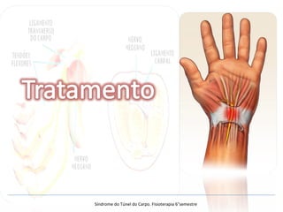 Síndrome do Túnel do Carpo. Fisioterapia 6°semestre
 