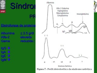 PROPEDÊUTICA Eletroforese de proteínas Albumina  <  2.5 g/dl Alfa-2 elevada Gama reduzida  (  sugere etiologia secundaria) IgG IgA IgE IgM  